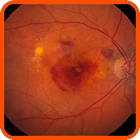 marco degeneracion macular