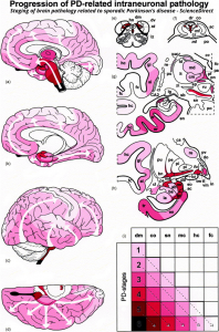 Estadificación de la patología cerebral relacionada con la enfermedad de Parkinson esporádica